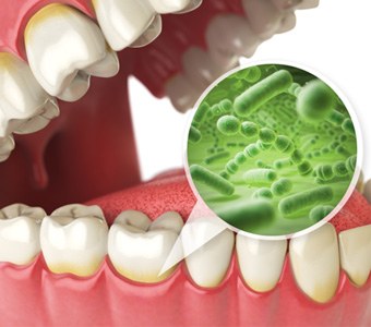 A 3D illustration highlighting bacteria around the gumline