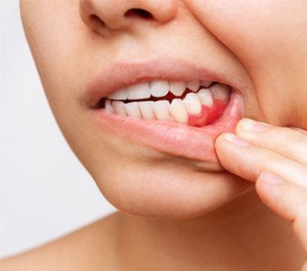 A woman revealing her red and inflamed gums