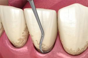 A 3D illustration of a scaling and root planing treatment