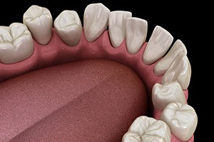 Illustration of gapped teeth