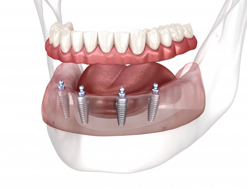 digital image of All-on-4 dental implants on lower arch