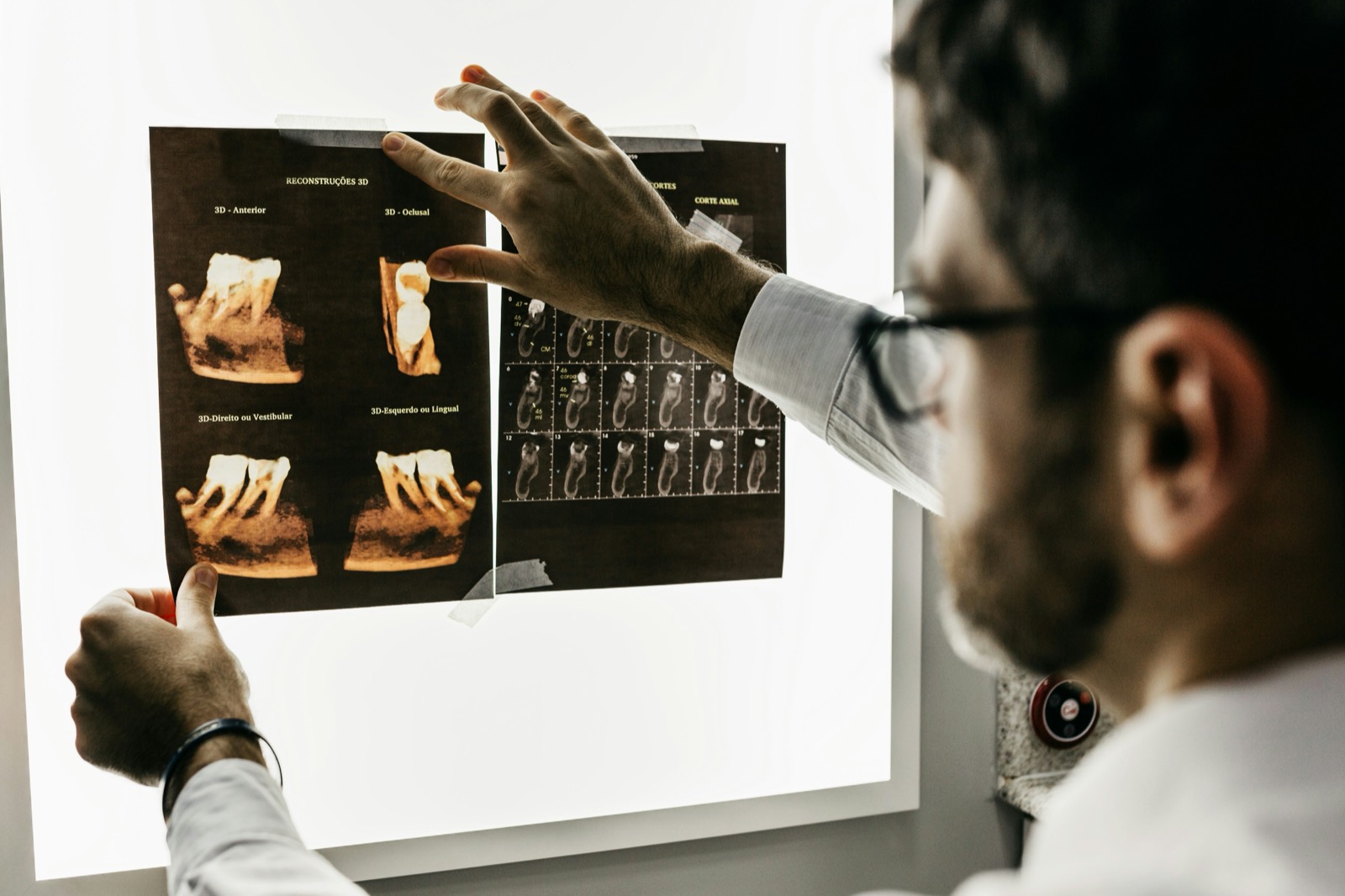 Dentist reviewing 3D CBCT scans of a tooth on a lightbox during an implant consultation