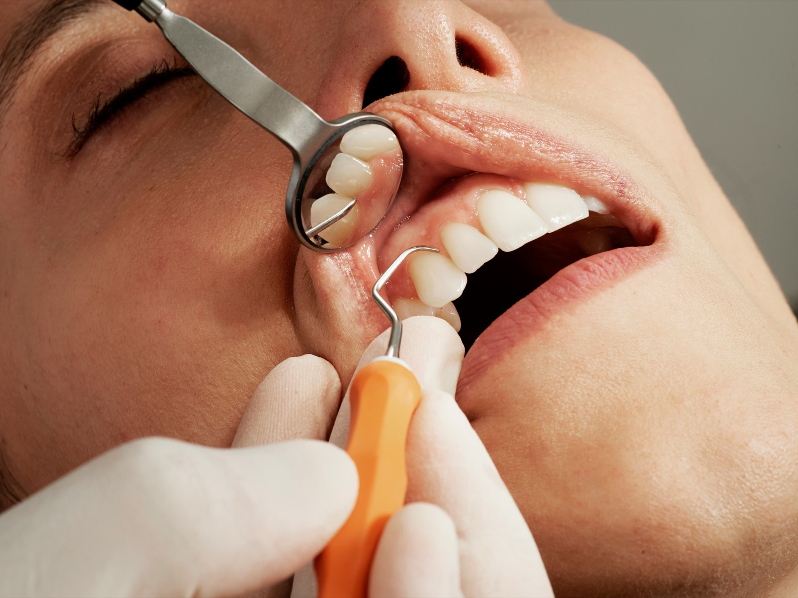 Dentist examining a patient's gum line with a mouth mirror and periodontal scaler