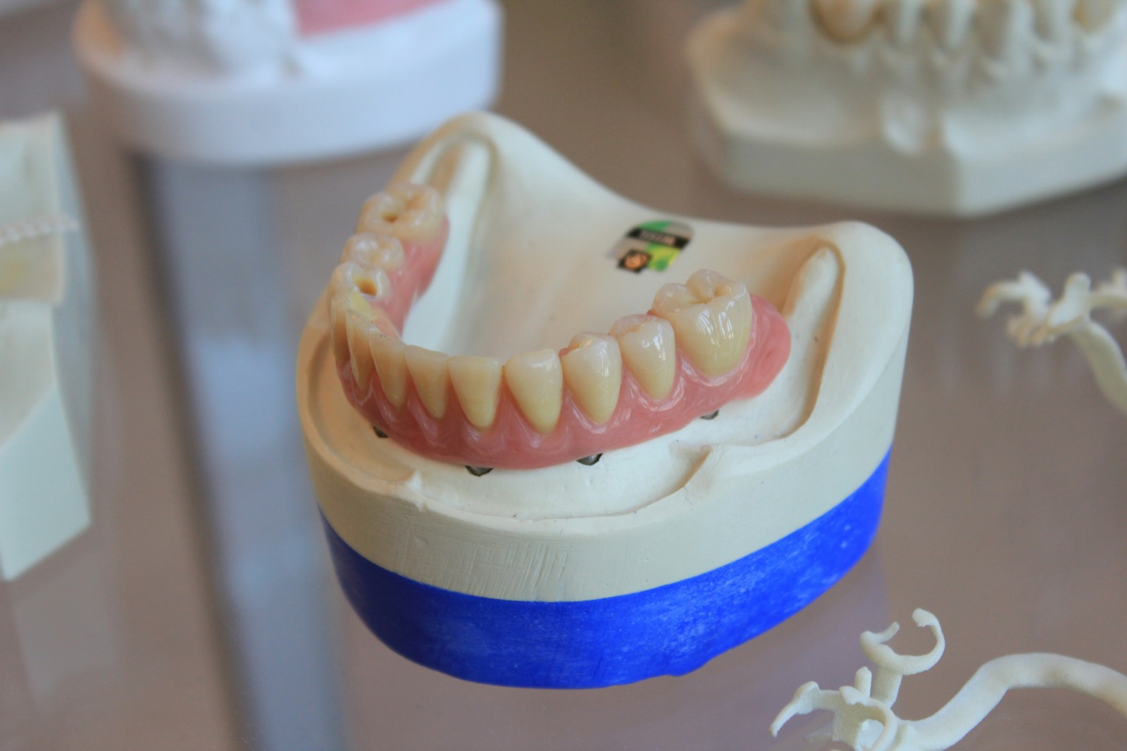 Implant-retained denture seated on a dental cast showing the attachment points