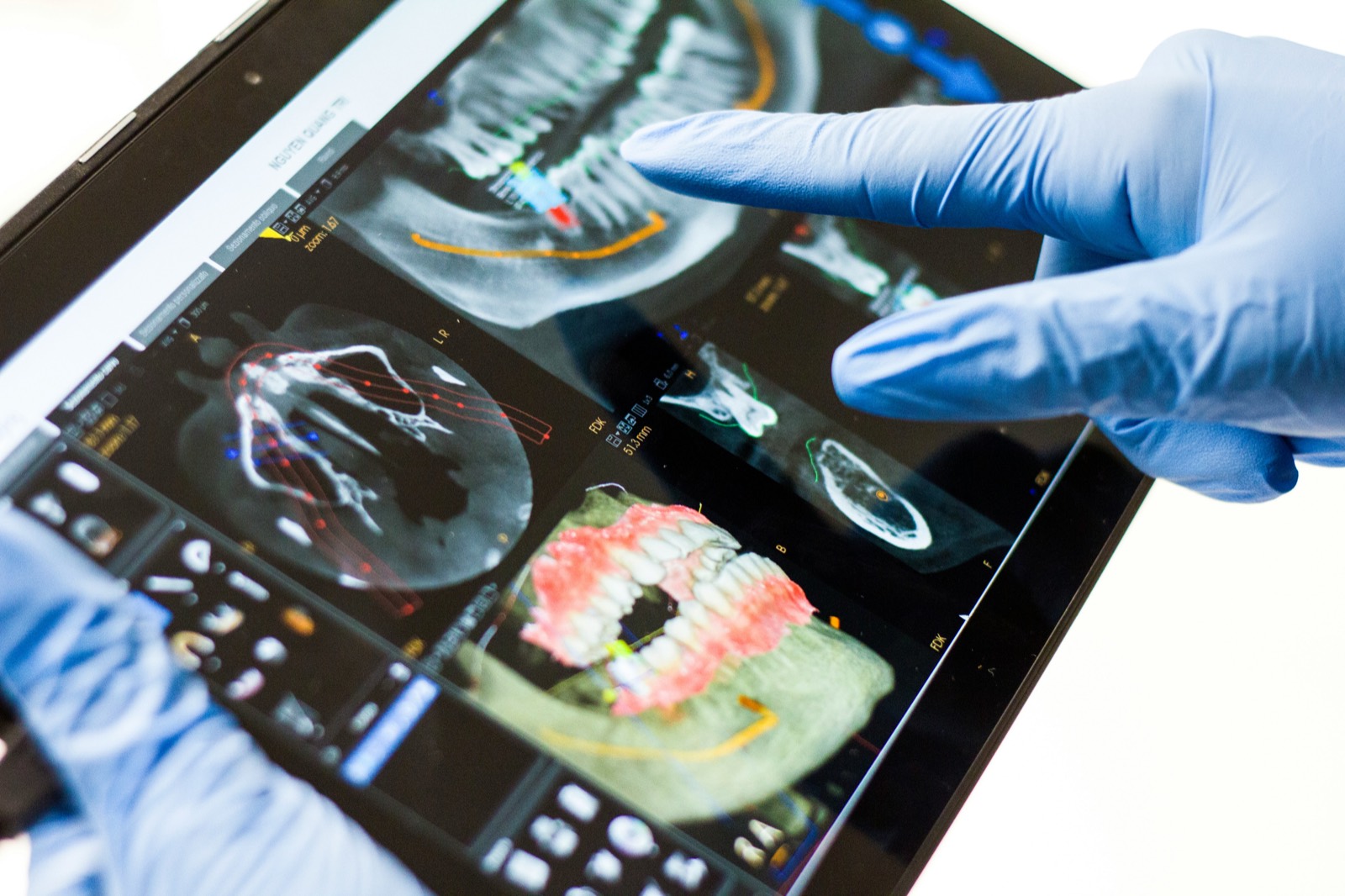 Clinician reviewing CBCT implant planning scans on a tablet